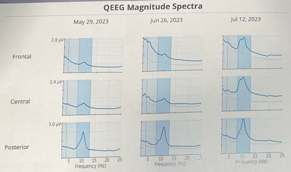 The QEEG Magnitude Spectra section of the Neurosynchrony report. 