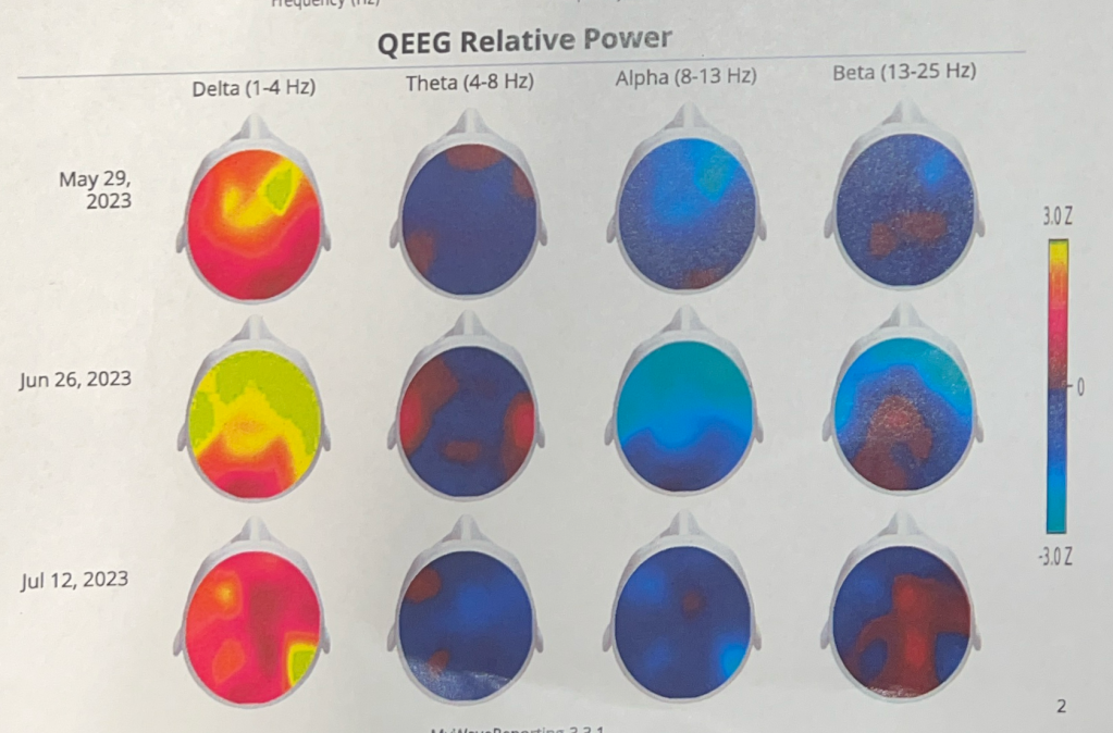The QEEG Relative Power section of the Neurosynchrony report. 